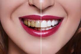 When to Get Veneers