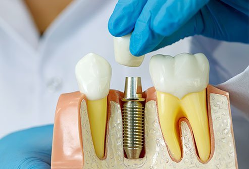 How Important Are Dental Implants For Your Teeth?